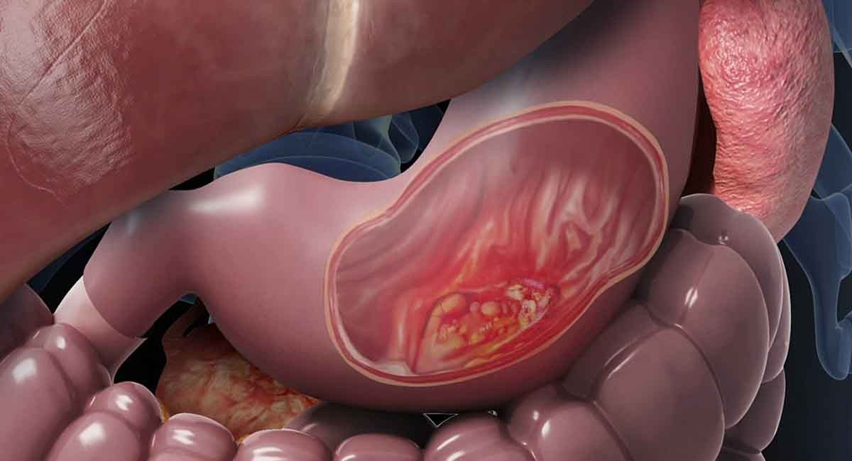 Nhung benh ung thu co the mac do tieu thu thuc pham ban-Hinh-2