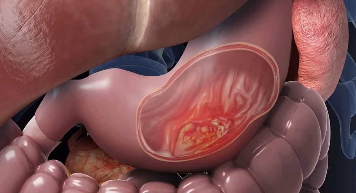 Nhung benh ung thu co the mac do tieu thu thuc pham ban-Hinh-2