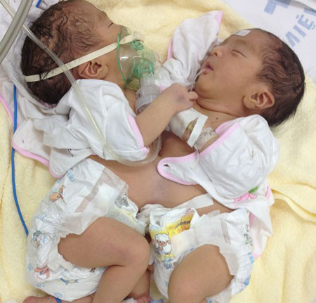 Cặp song sinh lúc chưa được phẫu thuật tách rời.