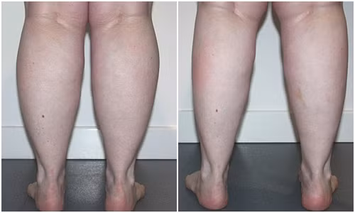 Cũng giống như điều trị xóa nhăn bằng botox trên khuôn mặt, tiêm bắp chân có giá từ 300 USD đến 2.000 USD cho một lần điều trị, kỹ thuật không phẫu thuật, không xâm lấn và chỉ mất vài phút để hoàn thành.