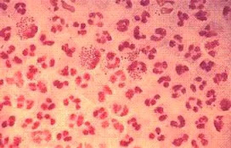 Khi nhiễm các bệnh lây truyền qua đường tình dục. Mọi hành vi tình dục có liên quan với các chất dịch cơ thể của người khác cần phải rất cẩn thận vì nó có chứa một số nguy cơ lây truyền các bệnh qua đường tình dục. Khi đã chắc chắn mình mắc bệnh lây truyền qua đường tình dục thì tuyệt đối kiêng “chuyện ấy” và chữa trị dứt điểm.