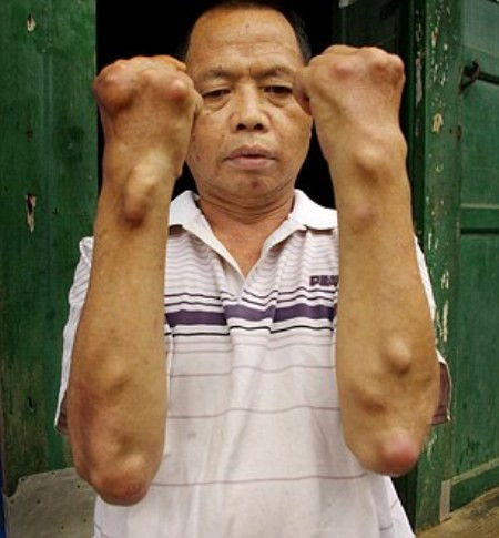 Người anh trai của ông Huang, 61 tuổi cũng bị nổi u chi chít và phải nằm liệt giường trong nhiều năm trời.