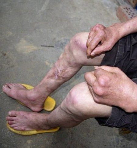 Những người dân sống ở đây còn bị nhiều căn bệnh khác như sưng phù đau đớn, cơ thể mệt mỏi, đau xương khớp do bị nhiễm độc cadmium nặng.