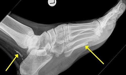Ảnh chụp X-quang cho thấy các mảnh giun phân hủy trong bàn chân bệnh nhân.