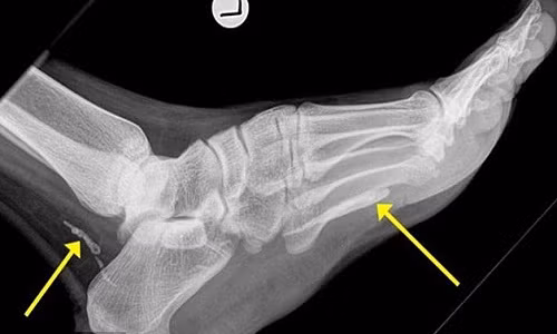 Ảnh chụp X-quang cho thấy các mảnh giun phân hủy trong bàn chân bệnh nhân.