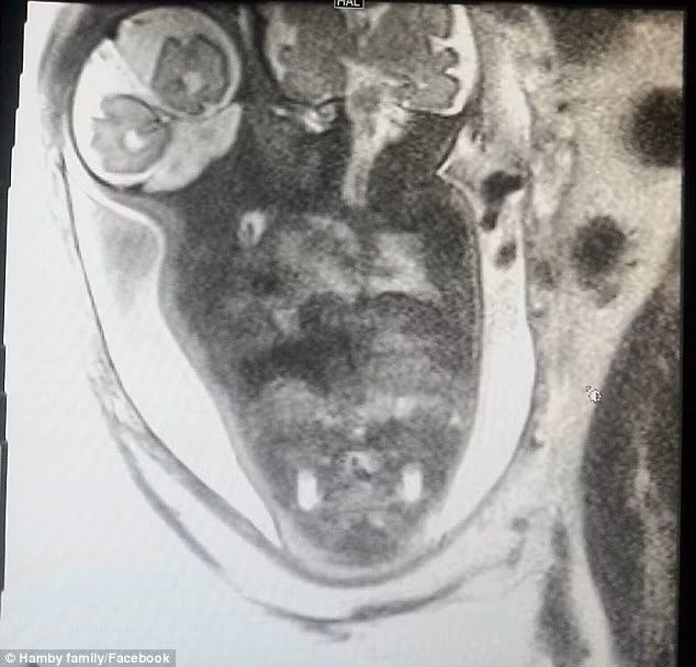 Còn đây là bản scan MRI lúc 35 tuần cho thấy Asa và Eli Hamby trong tử cung có 2 đầu và bộ não khỏe mạnh.