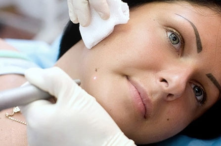 Còn khá nhiều trường hợp khác cũng đã bị những biến chứng xấu khi tự ý tẩy nốt ruồi và hậu quả là khôn lường. Hiện nay cũng có khá nhiều cơ sở tư nhân, cửa hàng cắt tóc gôị đầu hay spa cũng có dịch vụ tẩy nốt ruồi. Hầu hết các nơi này đều chưa được chứng nhận hay được sự kiểm tra chặt chẽ của cơ quan y tế nên cũng không đảm bảo cho bạn khi sử dụng dịch vụ.