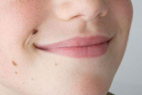 Axit có thể làm nốt ruồi bị tróc ra, nhưng rất dễ kèm theo da bị hoại tử dẫn đến viêm nhiễm ngứa, đau rát, có người còn bị sưng đỏ, mưng mủ rất khó chịu . Thậm chí, các lọai thuốc tẩy nốt ruồi này rất nhiều khả năng còn chứa cả chì và kim loại nặng nguy hiểm đến sức khỏe.