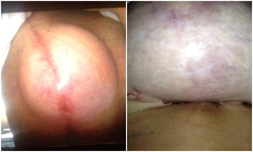 Phần ngực cấy ghép của Aston từng sưng to và phát nổ.