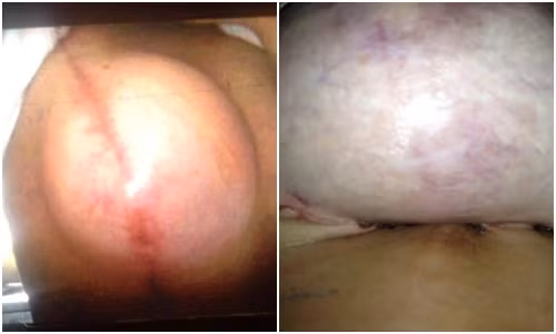 Phần ngực cấy ghép của Aston từng sưng to và phát nổ.