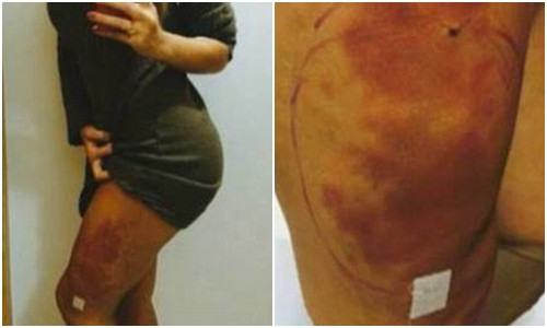 Vết hoại tử trên đùi Andressa Urach.