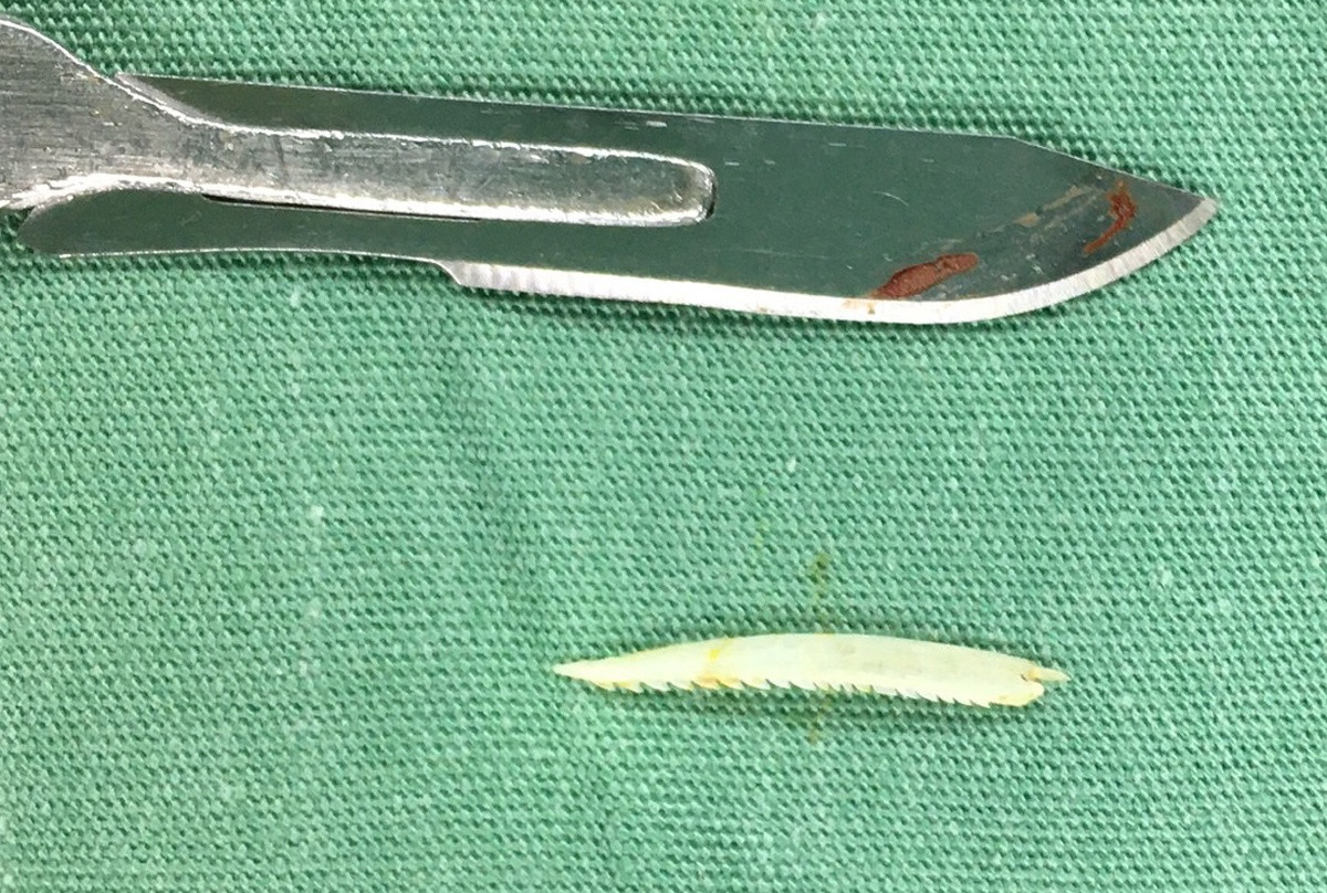 Suyt mat mang vi hoc xuong ca