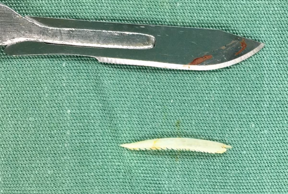 Suyt mat mang vi hoc xuong ca