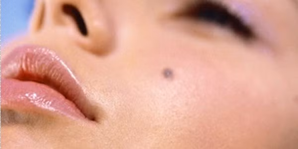 1. Nốt ruồi lồi cao. Những người sở hữu nốt ruồi lồi cao là những người gặp rất nhiều điều may mắn trong cuộc sống. Dường như thần may mắn luôn luôn mỉm cười với họ.