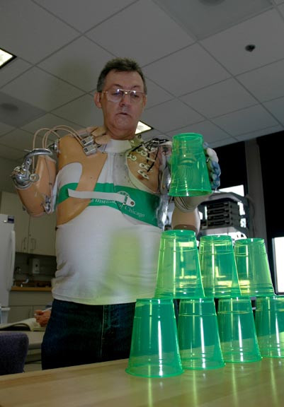 Jesse Sullivan là người tiên phong trong lĩnh vực này. Mặc dù có một tay sinh học giả nhưng Jesse không chỉ kiểm soát được tay bằng mà còn cảm được nhiệt độ và lực dùng để cầm vợt.