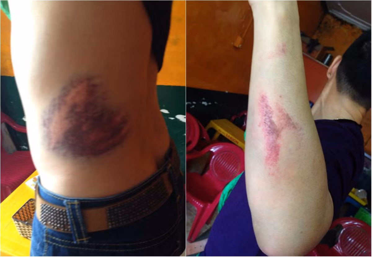 Long Ka chia sẻ ảnh anh bị 2 thanh niên đánh gây thương tích lên trang Facebook cá nhân.