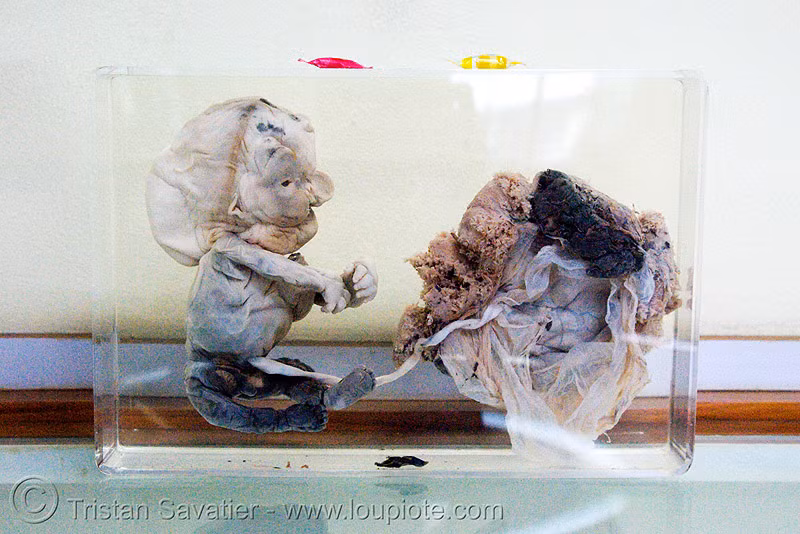 Bào thai dị dạng.