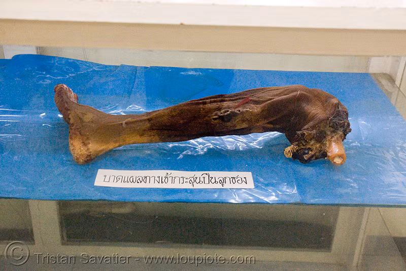 Một cẳng chân với vết thương từ đạn súng máy.