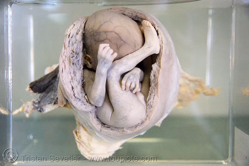 Một mẫu vật bào thai chết từ trong bụng mẹ. Hình ảnh được đăng trên tài khoản Flickr của nhiếp ảnh gia Pháp Tristan Savatier.