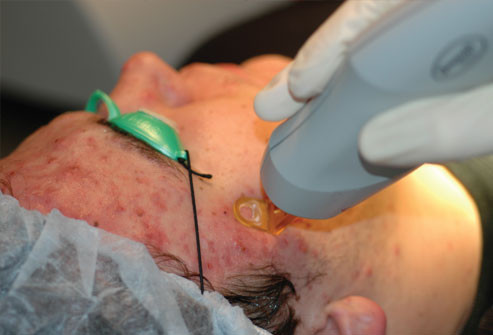 Laser diode: Với những người bị mụn trứng cá nặng, cần điều trị bằng các liệu pháp laser khác. Laser diode có thể phá hủy các tuyến dầu đang nuôi dưỡng mụn trứng cá. Giống Laser nonablative, Laser diode xuyên qua bên dưới bề mặt mà không làm hỏng lớp ngoài cùng của da. Tác dụng phụ chính là tình trạng đỏ trong ngắn hạn và viêm, nhưng thường không cần phải có thời gian phục hồi.