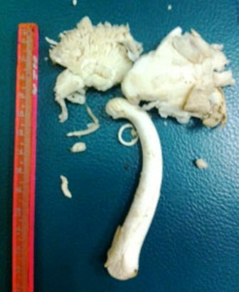 Loại nấm mà các bệnh nhân ăn phải