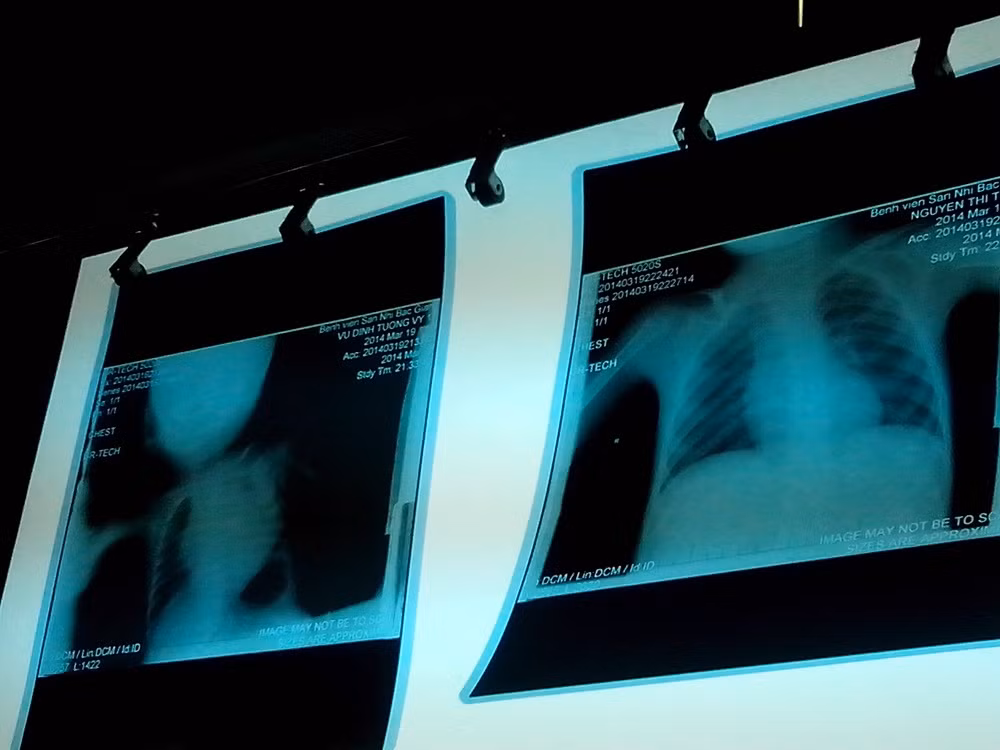 Phim chụp tim của bệnh nhi Vi (bên trái) có hình ảnh tim to hơn bình thường