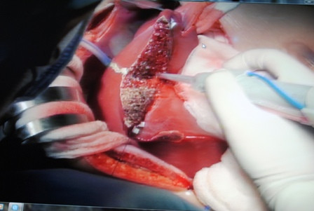 Ghép gan là biện pháp đã được đề cập đến để cứu các nạn nhân ngộ độc nấm