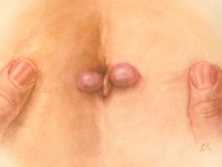 Tiếp đó, bệnh nhân dễ đối diện với tình trạng sa búi trĩ. Dấu hiệu này xuất hiện sau khi tình trạng đại tiện ra máu diễn ra một thời gian. Rất có thể việc nỗ lực đẩy chất thải ra ngoài khiến búi trĩ bị đẩy nhô ra phía ngoài hoặc sa hẳn ra vùng hậu môn.