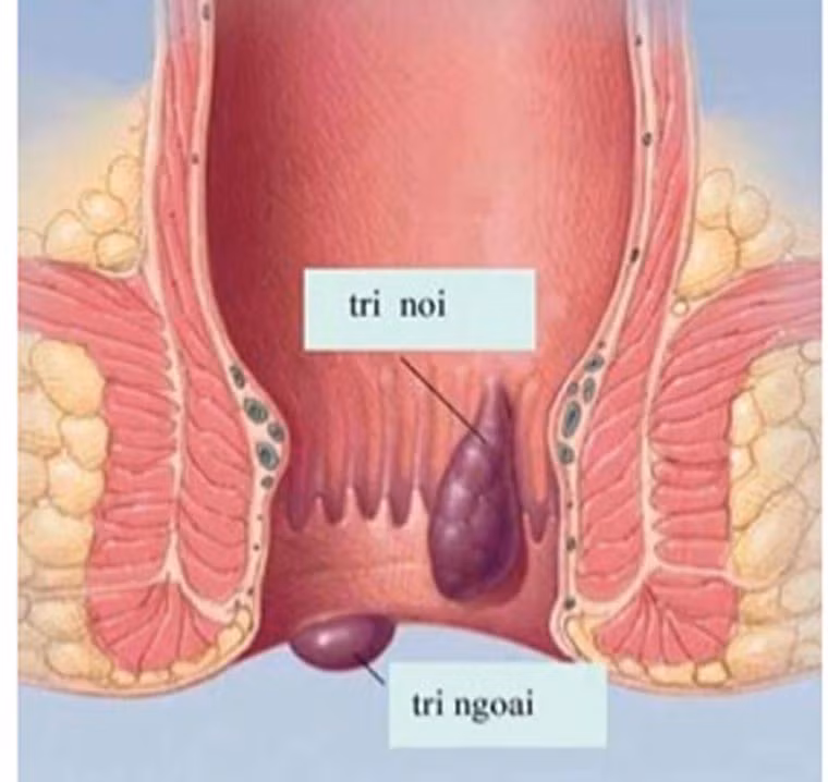 Ngoài ra, bệnh nhân còn bị ngứa hoặc dị ứng ở hậu môn. Triệu chứng này bắt nguồn từ việc búi trĩ sa ra ngoài, tiết dịch gây viêm da quanh hậu môn, làm cho bệnh nhân cảm giác lúc nào cũng ướt át và ngứa ngáy.