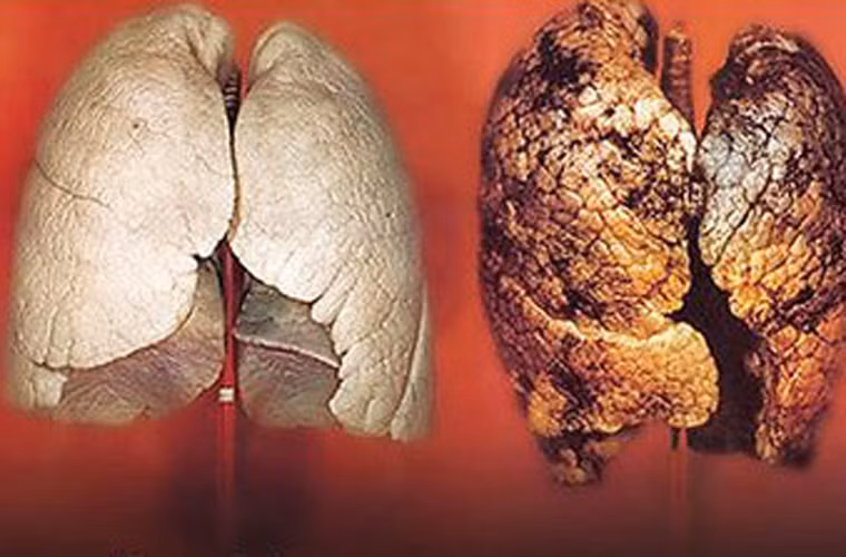 Thực sự, người ta chưa xác định được nguyên nhân chính xác gây ung thư phổi. Ngoài thuốc lá, còn nhiều yếu tố khác khiến khả năng mắc bệnh của một người tăng cao.