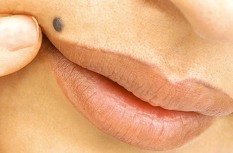 Không khám sức khỏe khi phát hiện nốt ruồi đáng ngờ. Nếu xuất hiện dấu hiệu như nốt ruồi trở nên to quá khổ, cạnh mờ, không rõ nét hoặc lởm chởm như răng cưa thì bạn cần đề cao cảnh giác. Một nốt ruồi “khỏe mạnh” sẽ dễ dàng xác định được vùng viền ngoài với vùng da lân cận; tròn và có kích thước khoảng 6 milimet.