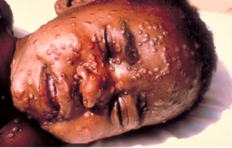 Tránh lại gần khu vực ổ dịch. Ở người, virus Ebola lây lan qua cách tiếp xúc trực tiếp với máu và chất tiết từ cơ thể như phân, nước bọt, tinh dịch hoặc chất nhờn. Nó cũng dễ dàng thâm nhập cơ thể qua các vết xước nhỏ hoặc những tiếp xúc từ niêm mạc của người lành với người bệnh; thậm chí là qua một vật trung gian như chăn đệm, ga giường, quần áo và kim tiêm.