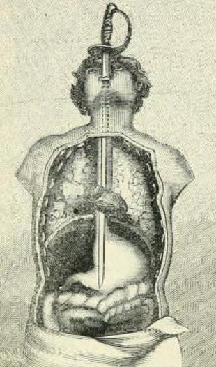 Bước thứ 4: Trên đường đi xuống dạ dày, thanh kiếm sẽ làm thẳng những khúc cong của thực quản.