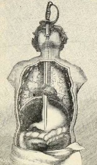 Bước thứ 4: Trên đường đi xuống dạ dày, thanh kiếm sẽ làm thẳng những khúc cong của thực quản.