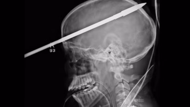 Trong khi đi câu cá với bạn, cậu bé Yasser Lopez (16 tuổi, Miami) bị một cây xiên cá chọc thẳng vào giữa trán. Nghe thật kinh hoàng nhưng cậu bé vẫn hoàn toàn tỉnh táo khi được đưa đến bệnh viện và hồi phục khá nhanh sau phẫu thuật.