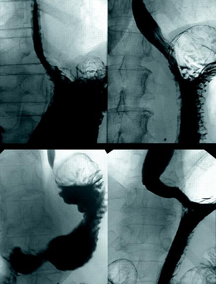 Tuy nhiên, thế giới cũng ghi nhận nhiều vụ thủng thực quản, rách dạ dày,... do lưỡi kiếm đi chệch.