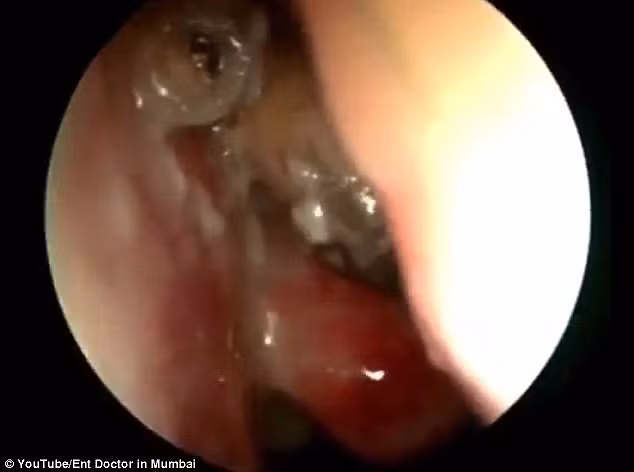 Nếu không phát hiện sớm và điều trị, các sinh vật này sẽ nhai thịt và xương trên khuôn mặt người bệnh, ăn dần lên mắt, gây nhiễm trùng như viêm màng não và khiến bệnh nhân tử vong.