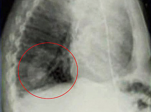 Theo các bác sĩ, có lẽ bệnh nhân đã ăn đậu, và có một hạt đã "đi lạc đường" xuống phổi, nảy mầm ở đó.