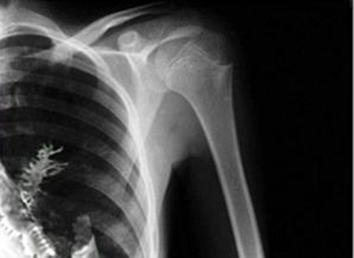 Các bác sĩ đoán rằng có thể trước đó bệnh nhân đã hít phải một hạt linh sam, hạt này nảy mầm và mọc thành một cây nhỏ trong phổi.