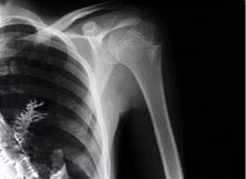 Các bác sĩ đoán rằng có thể trước đó bệnh nhân đã hít phải một hạt linh sam, hạt này nảy mầm và mọc thành một cây nhỏ trong phổi.