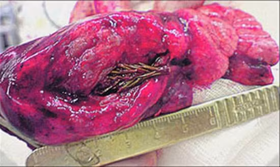 Vào năm 2009, khi mổ cắt u phổi cho một nam bệnh nhân, các bác sĩ Nga phát hiện một cây linh sam cao khoảng 5 cm mọc trong phổi, và đây chính là tác nhân khiến họ tưởng bệnh nhân bị ung thư, với triệu chứng đau dữ dội ở ngực và ho ra máu.