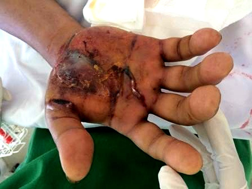 Ở các tỉnh này, rất nhiều người phải nhập viện vì bị rắn lục đuôi đỏ cắn. Nhiều người có những vết thương khủng khiếp.