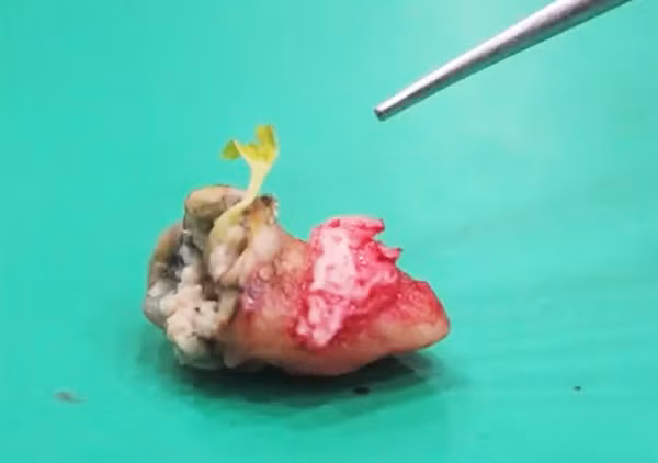 Năm 2011, một người đàn ông 36 tuổi ở Đài Loan đến nha sĩ vì răng khôn đau dữ dội. Khi nhổ chiếc răng ra, bác sĩ sửng sốt thấy một cây ổi nhỏ khoảng 10 ngày tuổi ở lỗ hổng trên răng. Bệnh nhân này ít vệ sinh răng miệng, nên hạt ổi giắt vào lỗ hổng răng sâu và mọc thành cây.