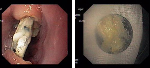 Cục pin trong thực quản cháu bé và khi được lấy ra. Cục pin trong thực quản cháu bé và khi được lấy ra.