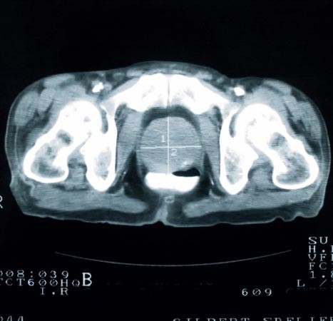 Ung thư tuyến tiền liệt chỉ gặp ở nam giới - đặc biệt là những người trên 50 tuổi. Tiến hành kiểm tra tuyến tiền liệt thường xuyên là điều bắt buộc với nam giới tuổi trung niên để tránh căn bệnh chết người này.