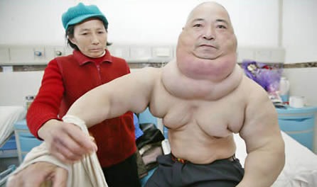 Huang Liqian nhận thấy biểu hiện bất thường trên cơ thể từ năm 1990, nhưng lại chủ quan cho qua. Kết quả là khối u có cơ hội phát triển tới 15kg. Rất may, khối u này đã được phẫu thuật cắt bỏ thành công năm 2007.