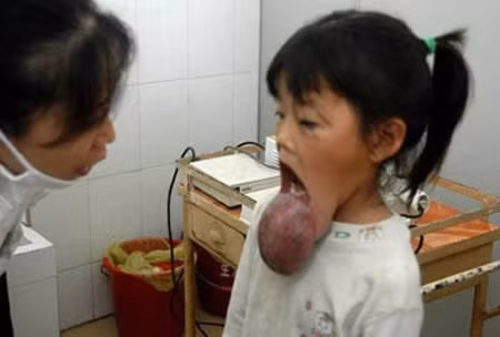 Cô bé 8 tuoir Gao An-ni mọc một khối u cực kỳ xấu xí ngay ở môi dưới. Càng đáng thương hơn nữa khi gia đình cô không đủ tiền để chi trả phẫu thuật cắt bỏ khối u đó cho em.