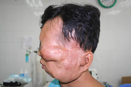 Khối u của người đàn ông này bắt đầu phát triển từ năm 7 tuổi. Đến nay, anh đã 29 tuổi nhưng vẫn không thể phẫu thuật do các rủi ro liên quan tới sự mất máu và chăm sóc sức khỏe sau phẫu thuật.