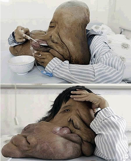 Huang Chuncai (Trung Quốc) “đeo” một khối u nặng tới 20kg trên mặt do ảnh hưởng của một chứng rối loạn di truyền hiếm gặp mang tên Neurofibromatosis.