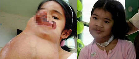 Đào Thị Lài (Việt Nam) trải qua thời thơ ấu đầy nước mắt với khối u kỳ dị trên mặt. Nhờ sự hảo tâm của các nhà từ thiện, Lài đã được phẫu thuật cắt bỏ thành công và đang có cuộc sống bình thường như bao thiếu nữ tuổi 20 khác.